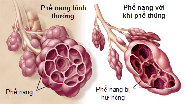 khí phế thũng